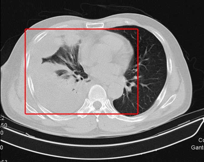 Hình chụp CT của bệnh nhân nam cho thấy phổi đông đặc, viêm dính, có nhiều ổ áp xe. Ảnh: Bệnh viện cung cấp.