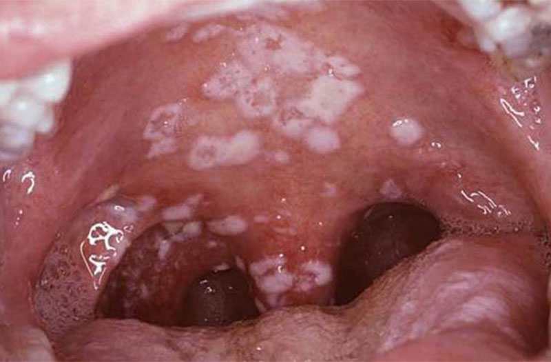 Triệu chứng bệnh lậu ở cổ họng