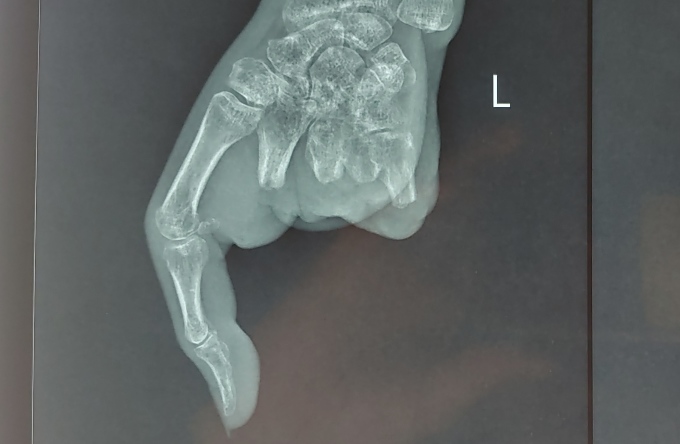 Ảnh chup X-quang bàn tay trái của bệnh nhân sau khi bị dập nát 4 ngón tay. Ảnh: Bệnh viện cung cấp