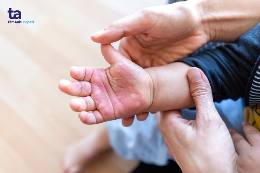 trẻ dễ bị bỏng ngày tết
