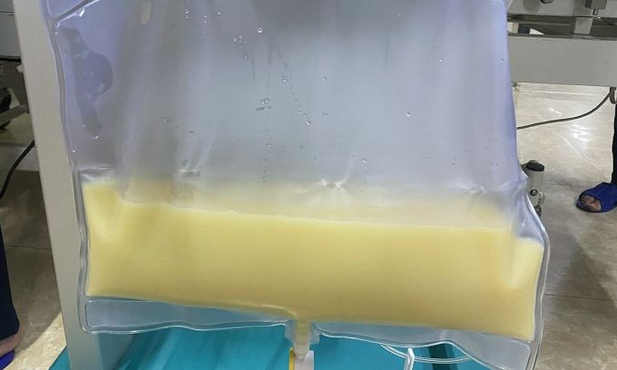 Huyết tương của bệnh nhân trắng đục như sữa do viêm tụy cấp. Ảnh: Bệnh viện cung cấp