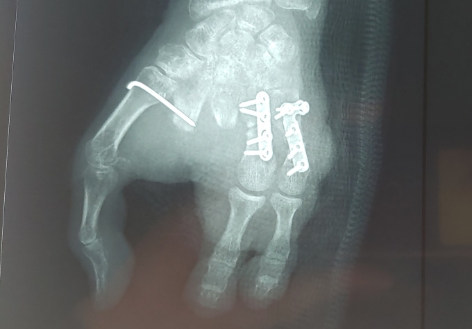Ảnh chụp X-quang bàn tay trái của bệnh nhân sau khi phẫu thuật. Ảnh: Bệnh viện cung cấp