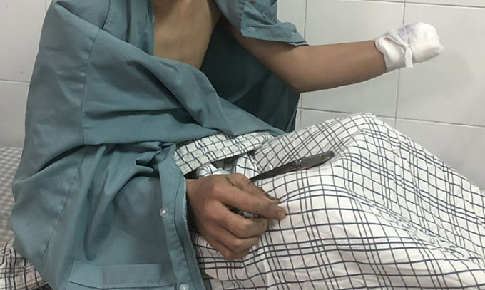 Bệnh nhân bị cụt tay do pháo nổ. Ảnh: Bệnh viện cung cấp
