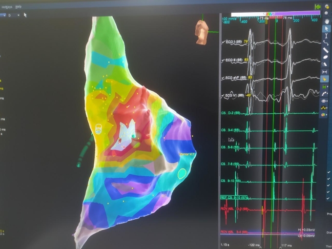 Hình ảnh ba chiều giải phẫu - điện học buồng nhĩ phải và điện tâm đồ ghi trong buồng tim của bệnh nhân 19 tuổi. Ảnh: BVĐK Tâm Anh