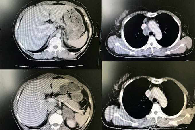 Từ trái qua phải, từ trên xuống dưới: hình ảnh khối u tại thời điểm chẩn đoán và sau lần lượt 3 chu kỳ điều trị. Ảnh: Bác sĩ cung cấp