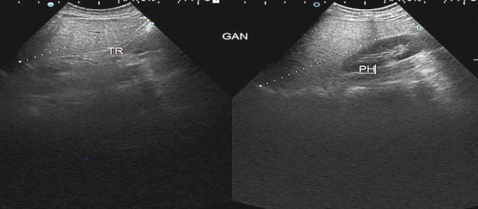 Hình ảnh siêu âm gan của bệnh nhân cho thấy gan trái (hình bên trái) phì đại. Ảnh: Bệnh viện cung cấp