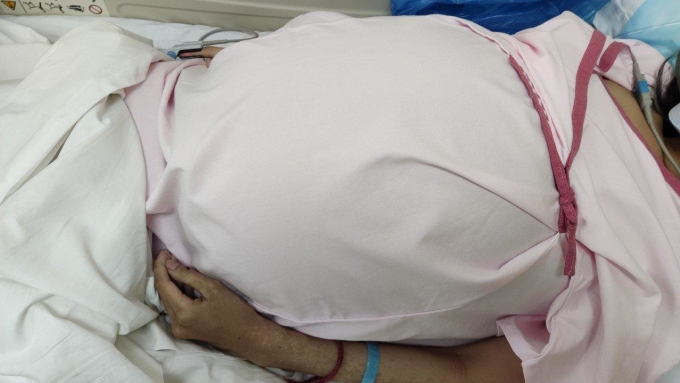 Người phụ nữ đi khám khi đã mang khối u lớn như có bầu đủ tháng. Ảnh: Bệnh viện cung cấp