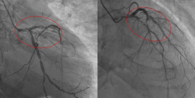 Hình ảnh chụp mạch vành trước mổ cho thấy các nhánh mạch máu chính nuôi tim bị xơ vữa, vôi hóa, hẹp 90-95%. Ảnh: Bệnh viện Tâm Anh