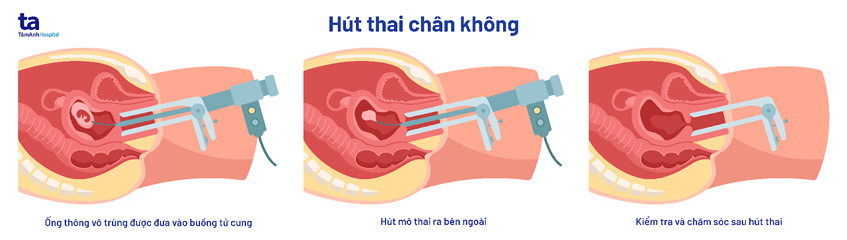 mô tả phương pháp hút thai chân không