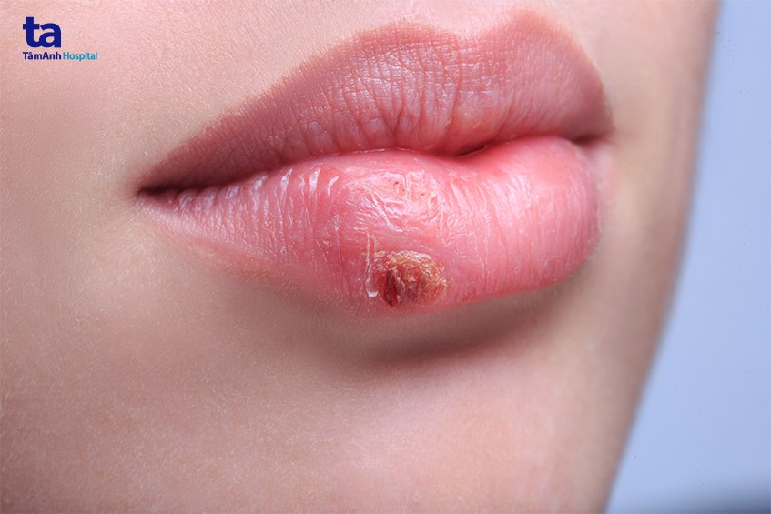 herpes sinh dục có lây không