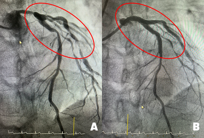 Hình ảnh chụp mạch vành cho thấy các mạch máu chính nuôi tim hẹp nặng (hình A) và được nong mở rộng tái thông dòng máu sau can thiệp (hình B).