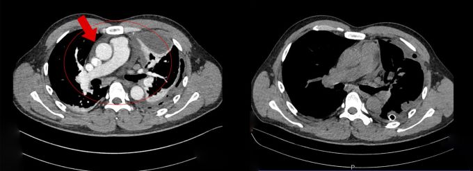 Ảnh chụp tràn dịch màng phổi trước (bên trái) và sau (bên phải) khi hút dịch mủ và mổ nội soi.