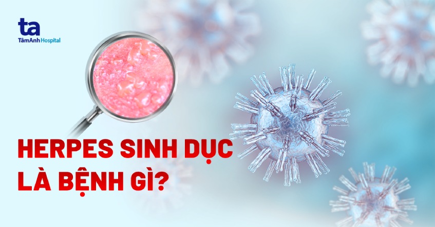 herpes sinh dục