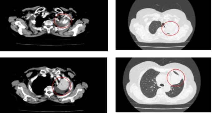 Hình ảnh chụp cắt lớp vi tính lồng ngực người bệnh phát hiện khối u trên phổi phải. Ảnh: Bệnh viện cung cấp