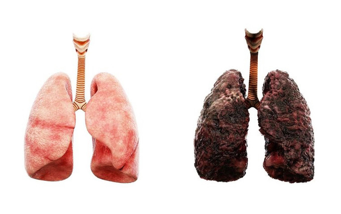 Sự khác biệt giữa phổi người khỏe mạnh (bên trái) và người hút thuốc (bên phải). Ảnh: Pinterest