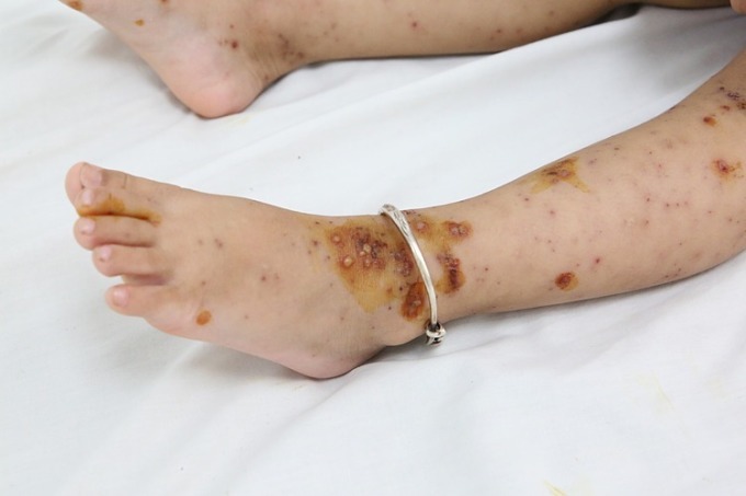 Một em bé mắc thuỷ đậu với biểu hiện nốt phỏng trên da. Ảnh: Bệnh viện cung cấp