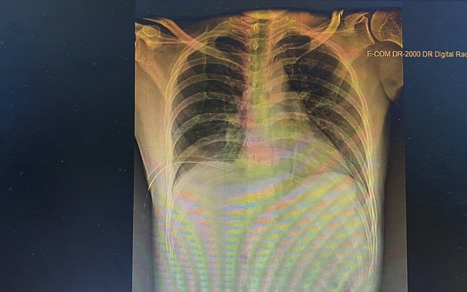 Hình ảnh viêm phổi, tràn dịch màng khí phổi trên phim chụp. Ảnh: Bệnh viện cung cấp