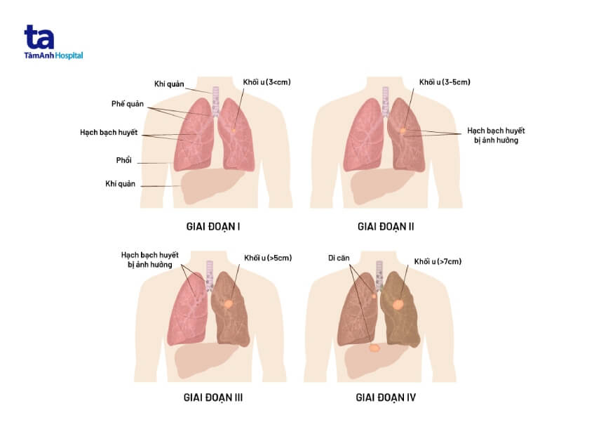 các giai đoạn ung thư phổi