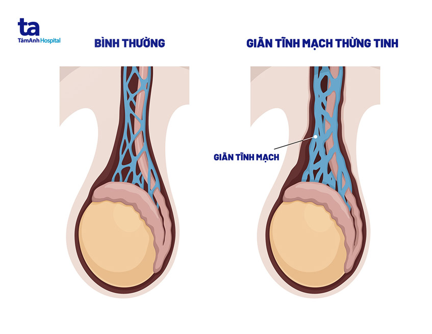 bị giãn tĩnh mạch thừng tinh