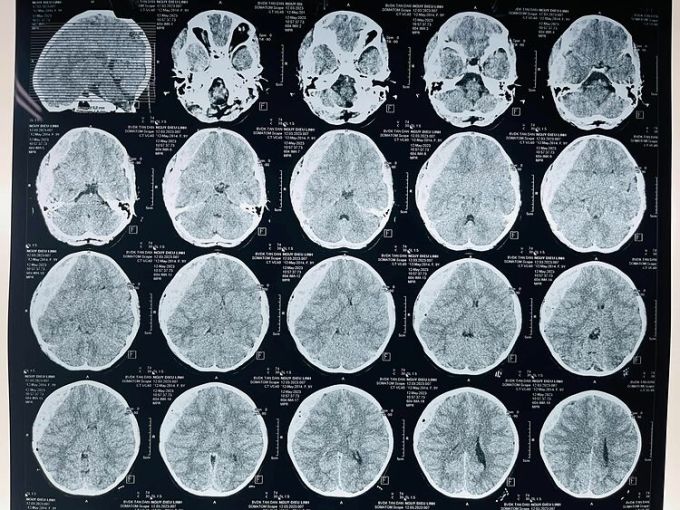 Hình ảnh chụp CT chấn thương sọ não của bệnh nhi. Ảnh: Bệnh viện cung cấp