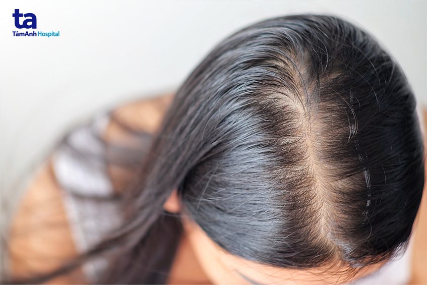 chẩn đoán tình trạng hói tóc ở nữ