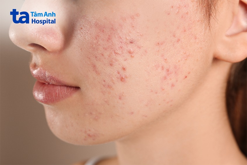 Dấu hiệu nhận biết mụn nội tiết