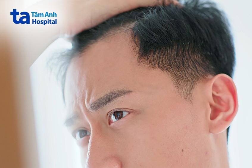 căng thẳng stress nguyên nhân gây hói đầu