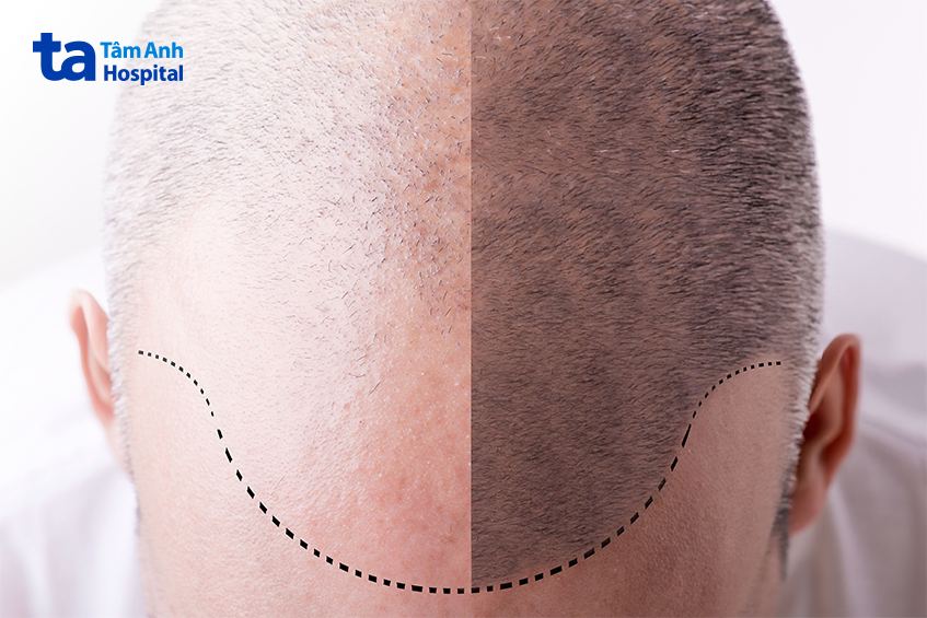 dấu hiệu nhận biết rụng tóc ở nam giới