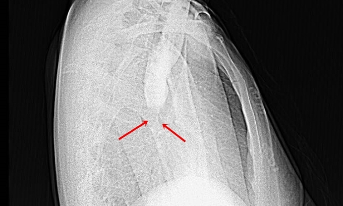 Hình ảnh X-quang ứ đọng thuốc cản quang thực quản, co thắt tại vị trí tâm vị. Ảnh: Bệnh viện cung cấp