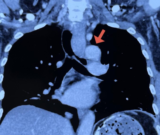 Hình ảnh khối u trung thất trên phim chụp CT. Ảnh: Bệnh viện Tâm Anh
