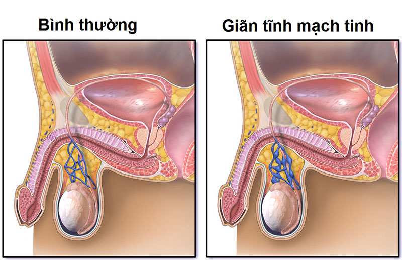 Giãn tĩnh mạch thừng tinh nhẹ