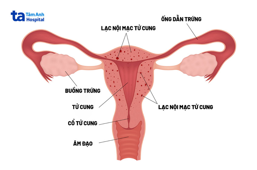 tử cung tiết khí hư có màu nâu