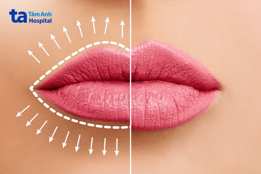 làm sao để giảm tác dụng phụ khi tiêm filler môi