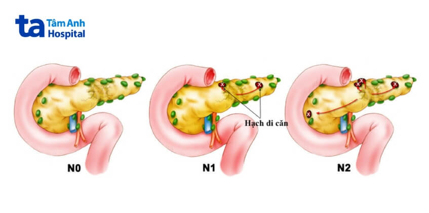 yếu tố n ung thư tuyến tụy