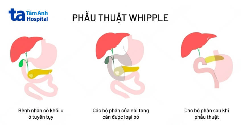 phẫu thuật điều trị ung thư tụy