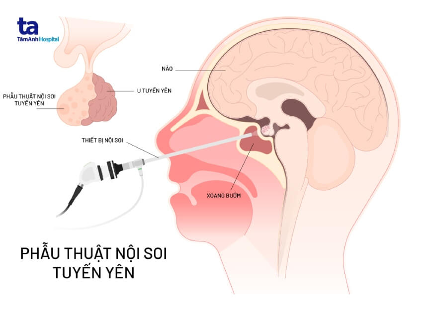 phương pháp phẫu thuật u tuyến yên