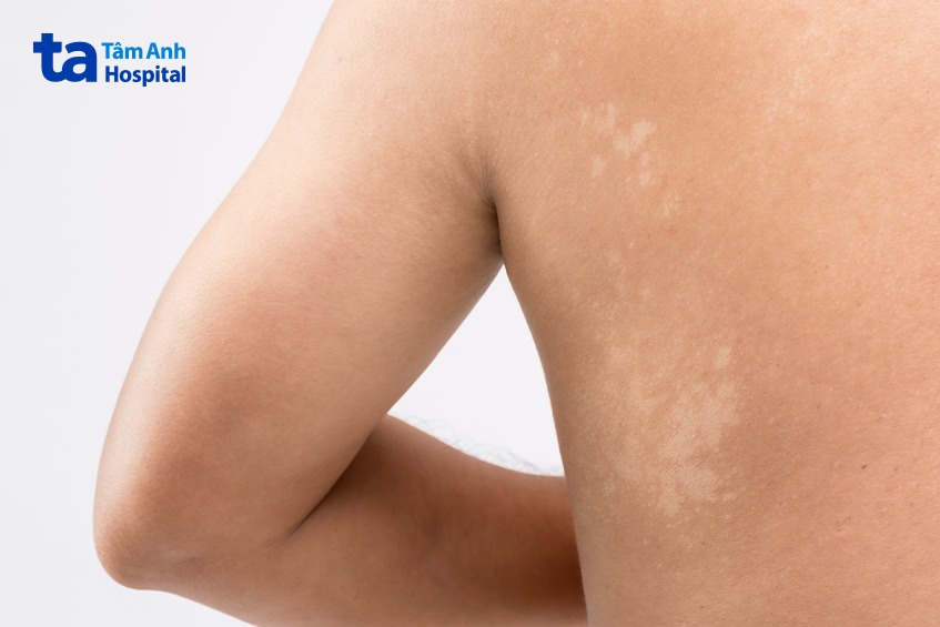 hình ảnh lang ben trắng bên lưng trái