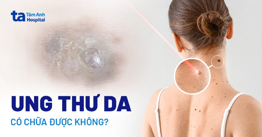 ung thư da có chữa được không