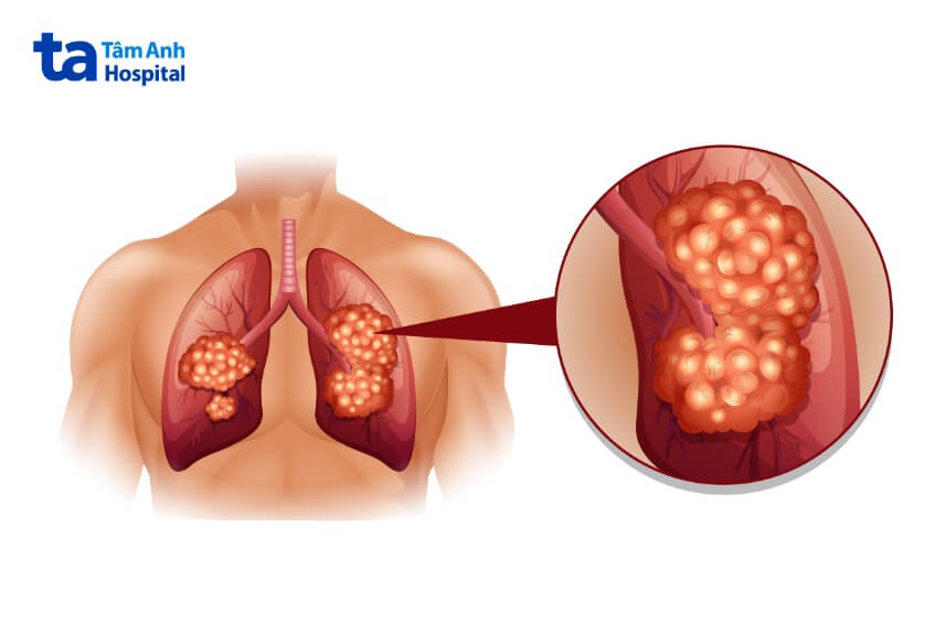 Ung thư phổi di căn có chữa được không?