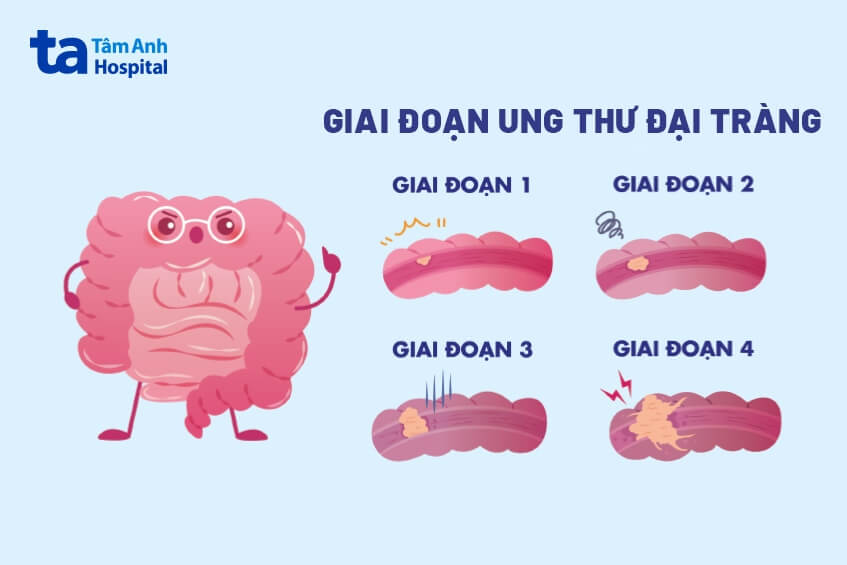 ung thư đại tràng di căn ở giai đoạn cuối