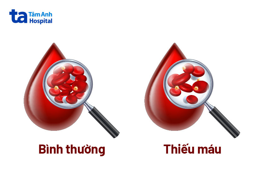 Thiếu máu khiến số lượng hồng cầu hoặc nồng độ huyết sắc tố trong trong hồng cầu thấp
