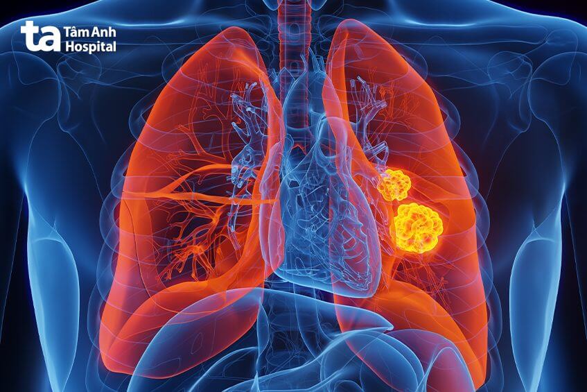 khối u ung thư phổi nguyên phát