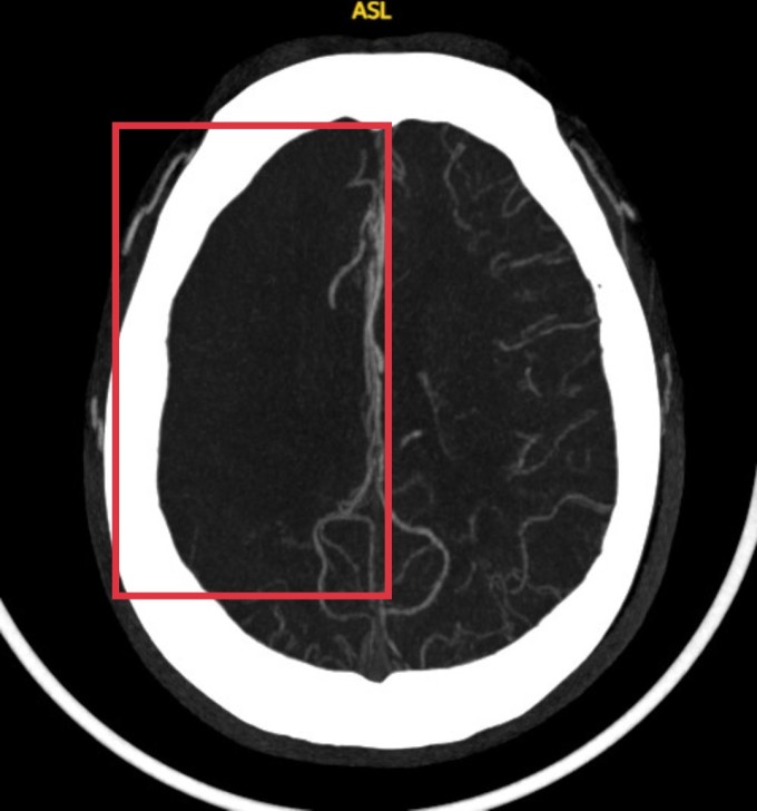 Vùng não thiếu máu (bên trong khung kẻ đỏ) khi bệnh nhân vào viện. Ảnh: Bệnh viện cung cấp