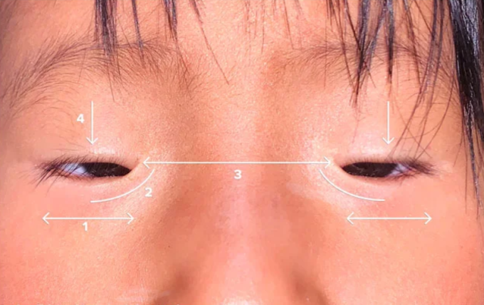 Bốn đặc trưng ở đôi mắt của người bệnh mang hội chứng BPES được TS.BS Jean-Paul Abboud (chuyên gia người Mỹ về phẫu thuật tạo hình Mắt-Mặt) mô tả trên y văn. Ảnh: Oculofacial Surgical Arts