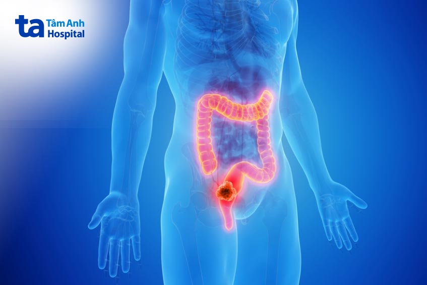 ung thư trực tràng ở giai đoạn 0 phương pháp phẫu thuật điều trị duy nhất