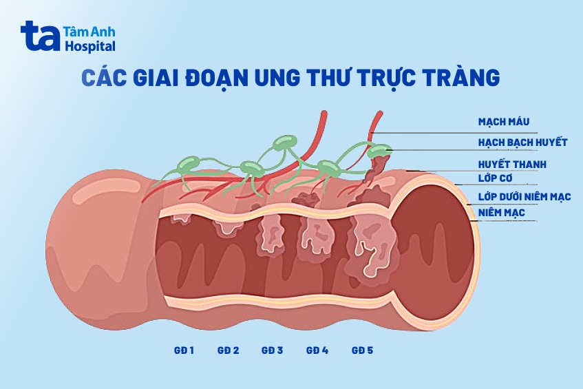 các giai đoạn ung thư trực tràng