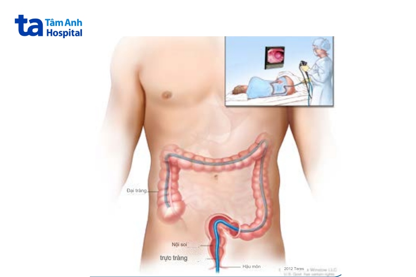 phương pháp nội soi tầm soát ung thư đại trực tràng