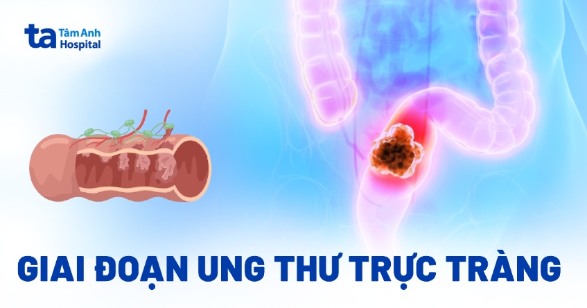 giai đoạn ung thư trực tràng