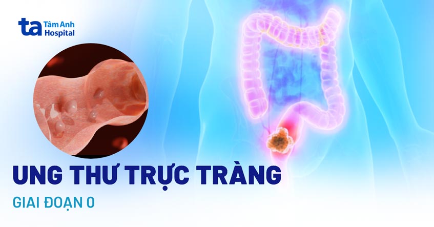 ung thư trực tràng giai đoạn 0