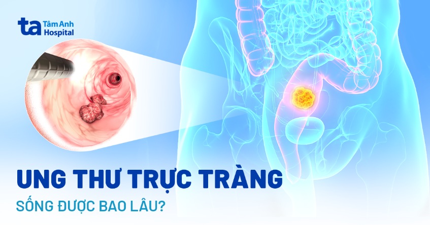 ung thư trực tràng sống được bao lâu